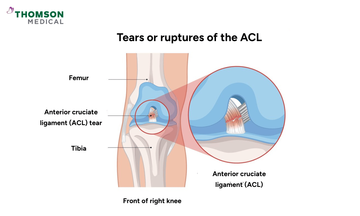 Anatomy Illustration of ACL Tear