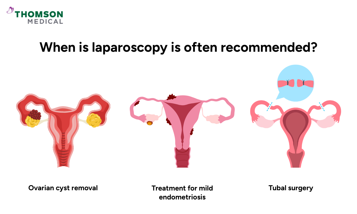 Illustration of when laparoscopy is often recommend