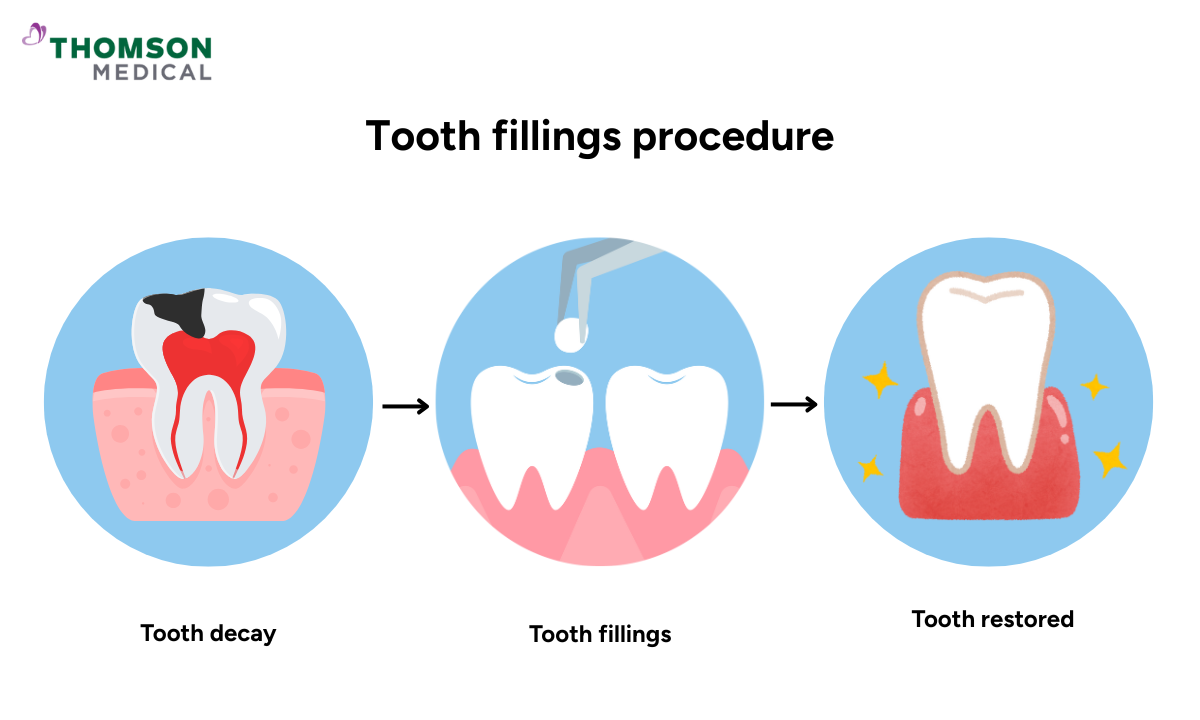 Illustration of tooth fillings procedure