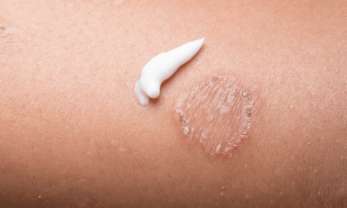 Close up of a ringworm