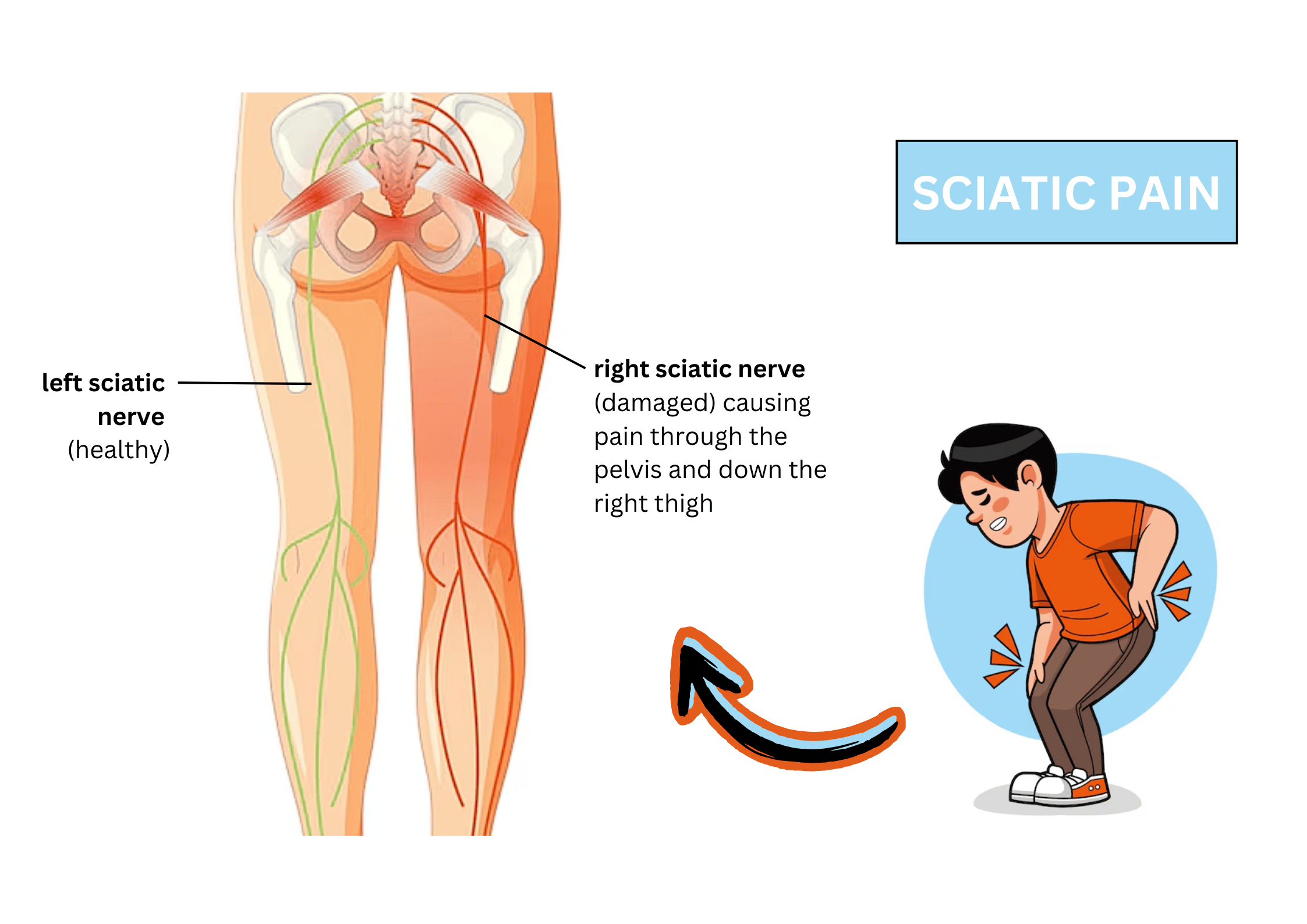 Sciatica: Causes, Symptoms, and Treatments | Thomson Medical Sciatica: Causes, Symptoms, and Treatments | Thomson Medical