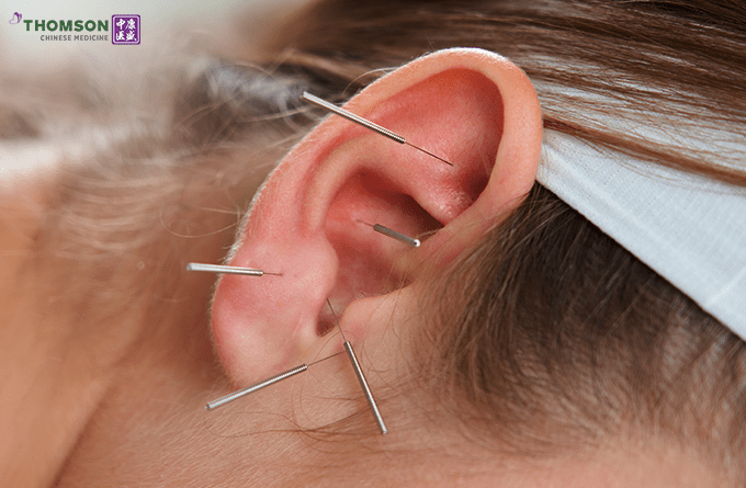 Role Of Acupuncture In Alleviating Chronic Pain 1.png