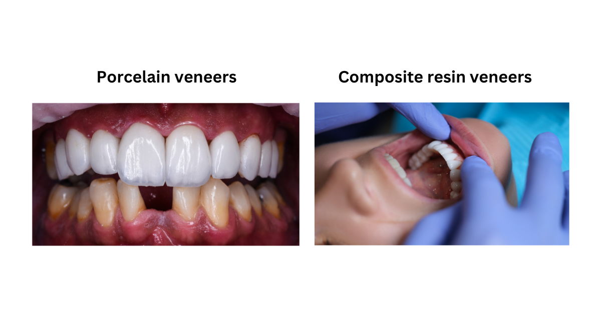 Types_of_dental_veneers_1200x630.png