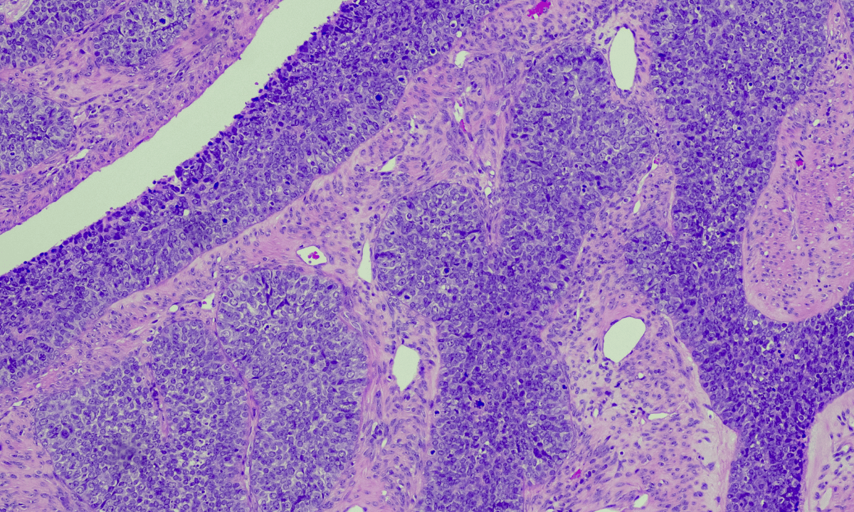 illustration of high grade ovarian cancer