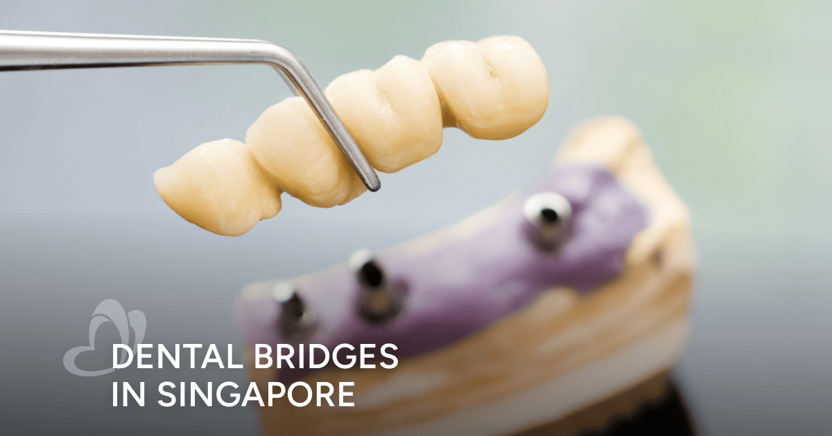 Dental Bridges in Singapore Thomson Medical