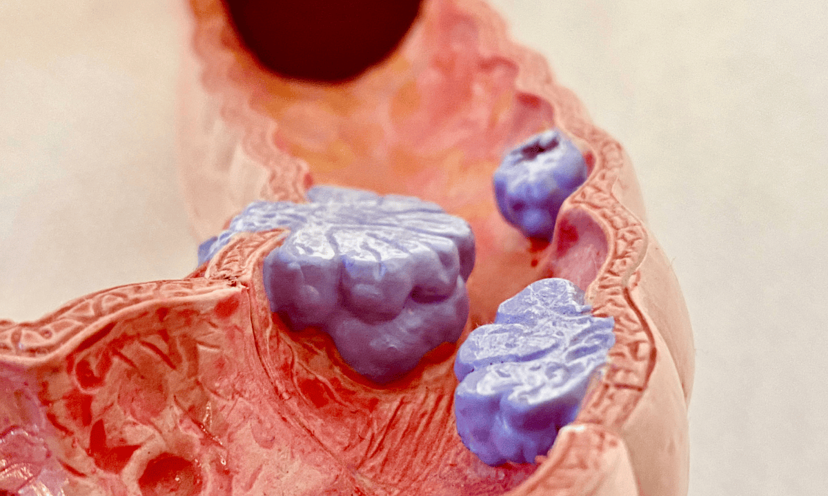 Colon polyps anatomical model