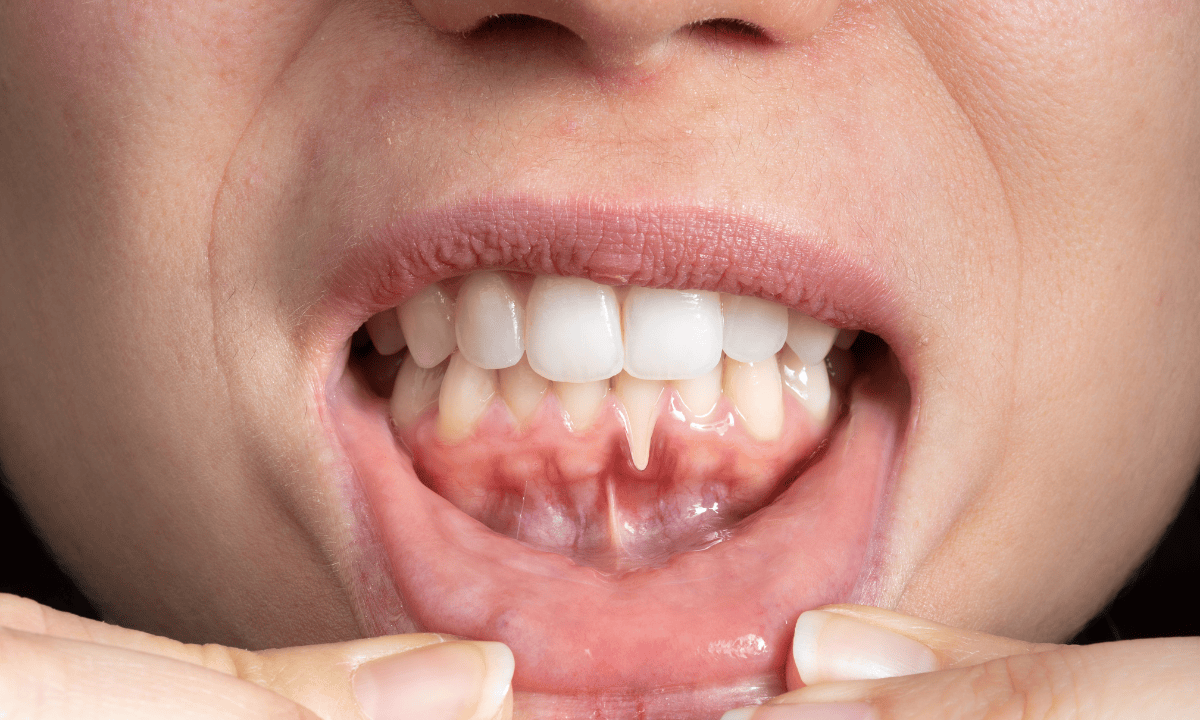image of receding gum in teenagers