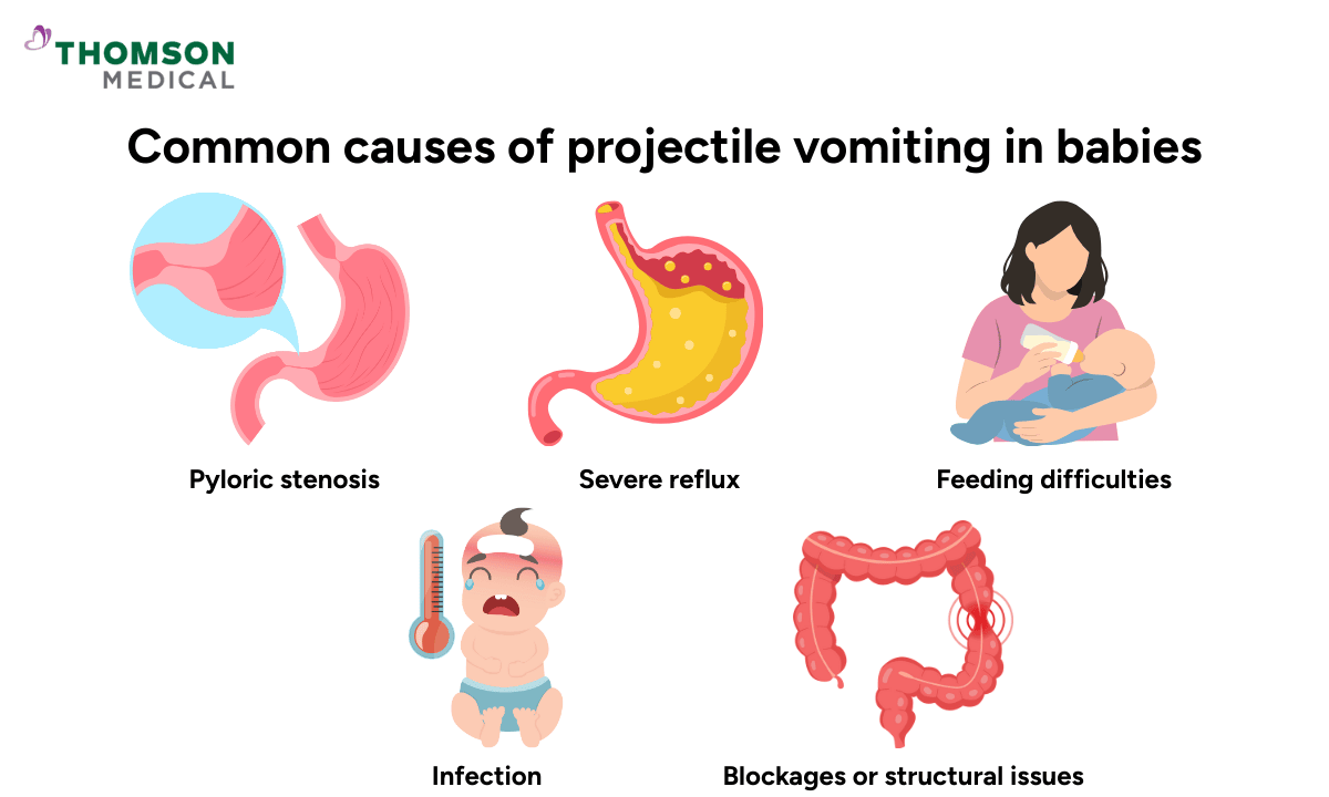 image of common causes of projectile vomiting in babies