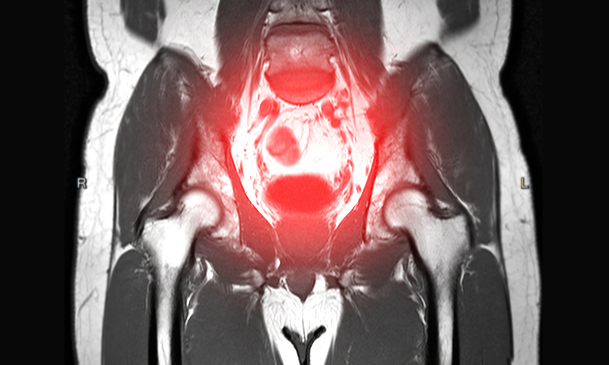 MRI scan of pelvis