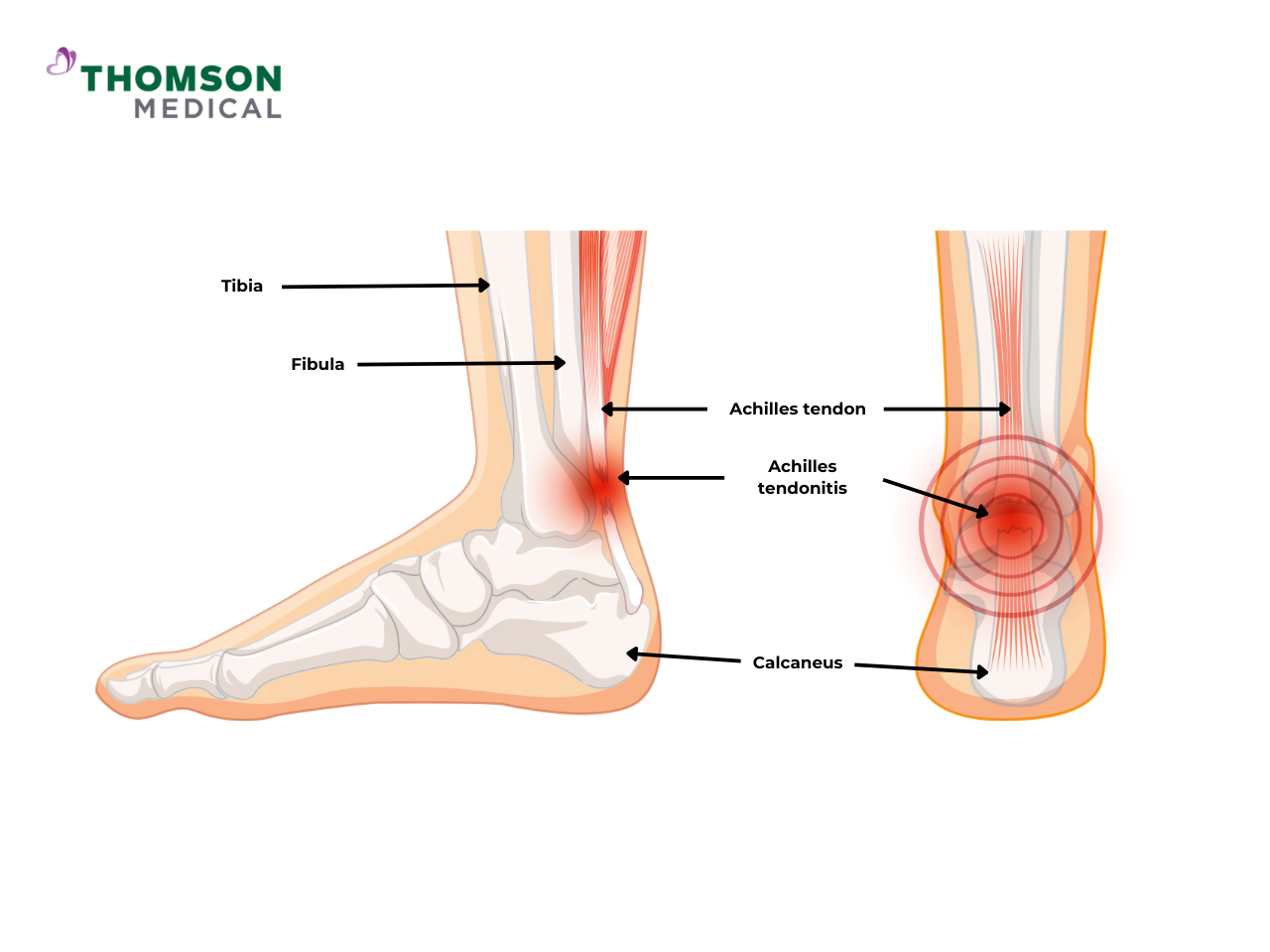 An illustration of the Achilles tendon and the surrounding muscles or bones