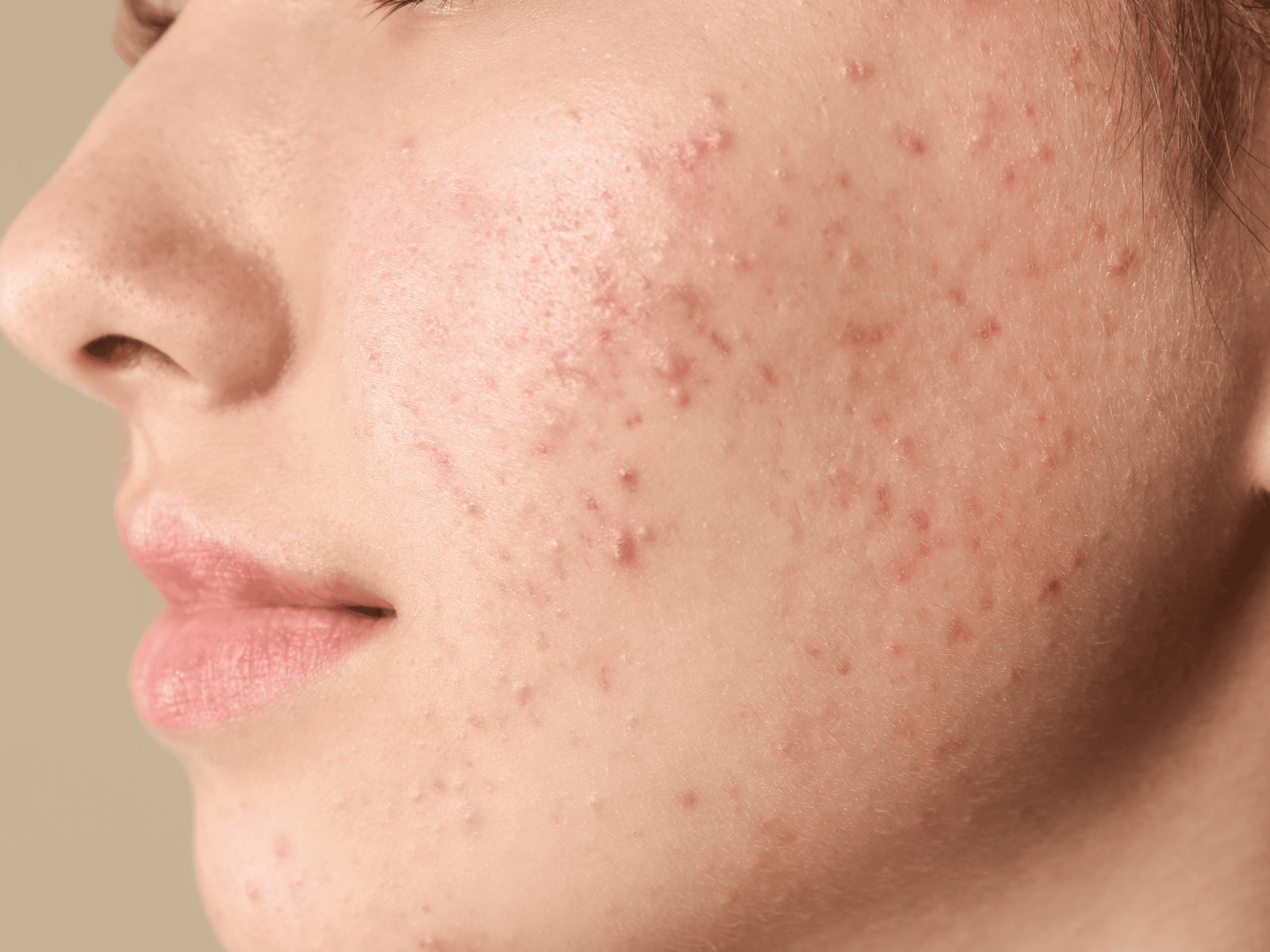 acne_article_(1).png