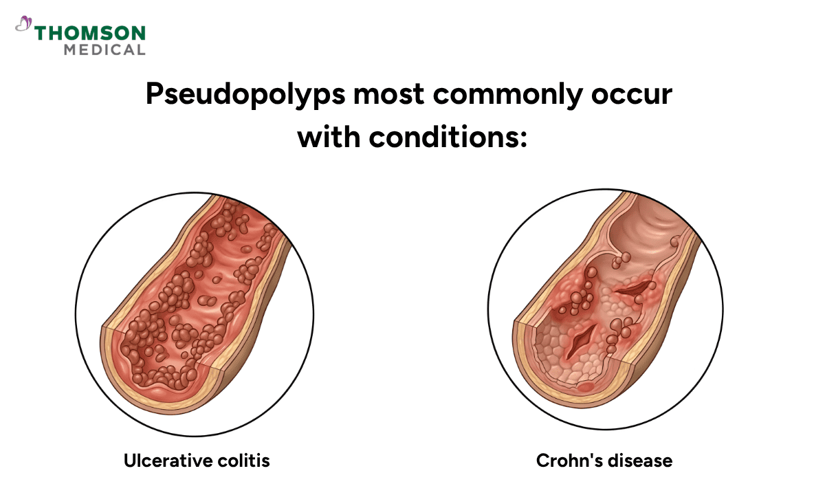 Medical illustration highlighting that pseudopolyps most commonly occur with Inflammatory Bowel Diseases (IBD), showing cross-sections of the colon affected by Ulcerative colitis and Crohn's disease.