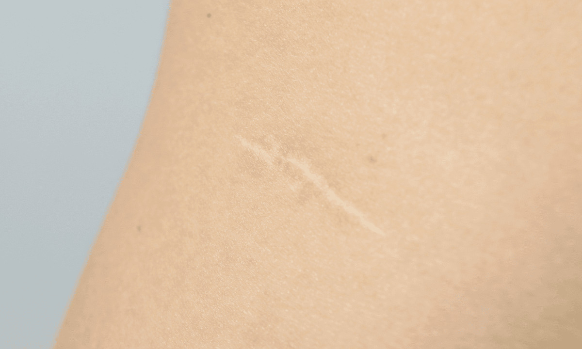 illustration-of-keyhole-hysterectomy-scars