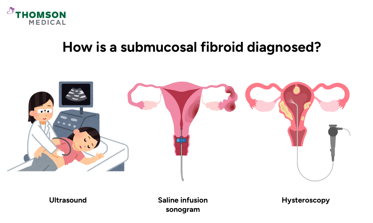 Illustration is showing on how is a submucosal fibroid diagnosed