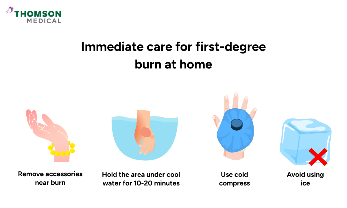 blog-image_ucc_immediate-care-for-first-degree-burn-at-home.png