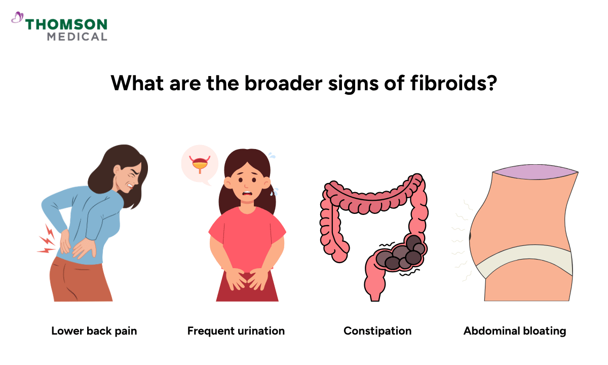 illustration of the broader signs of fibroids