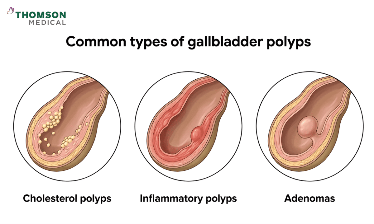 A medical illustration showing the three common types of gallbladder polyps: cholesterol polyps (small, multiple clusters), inflammatory polyps (a single reddish growth), and adenomas (a larger, rounded protrusion).