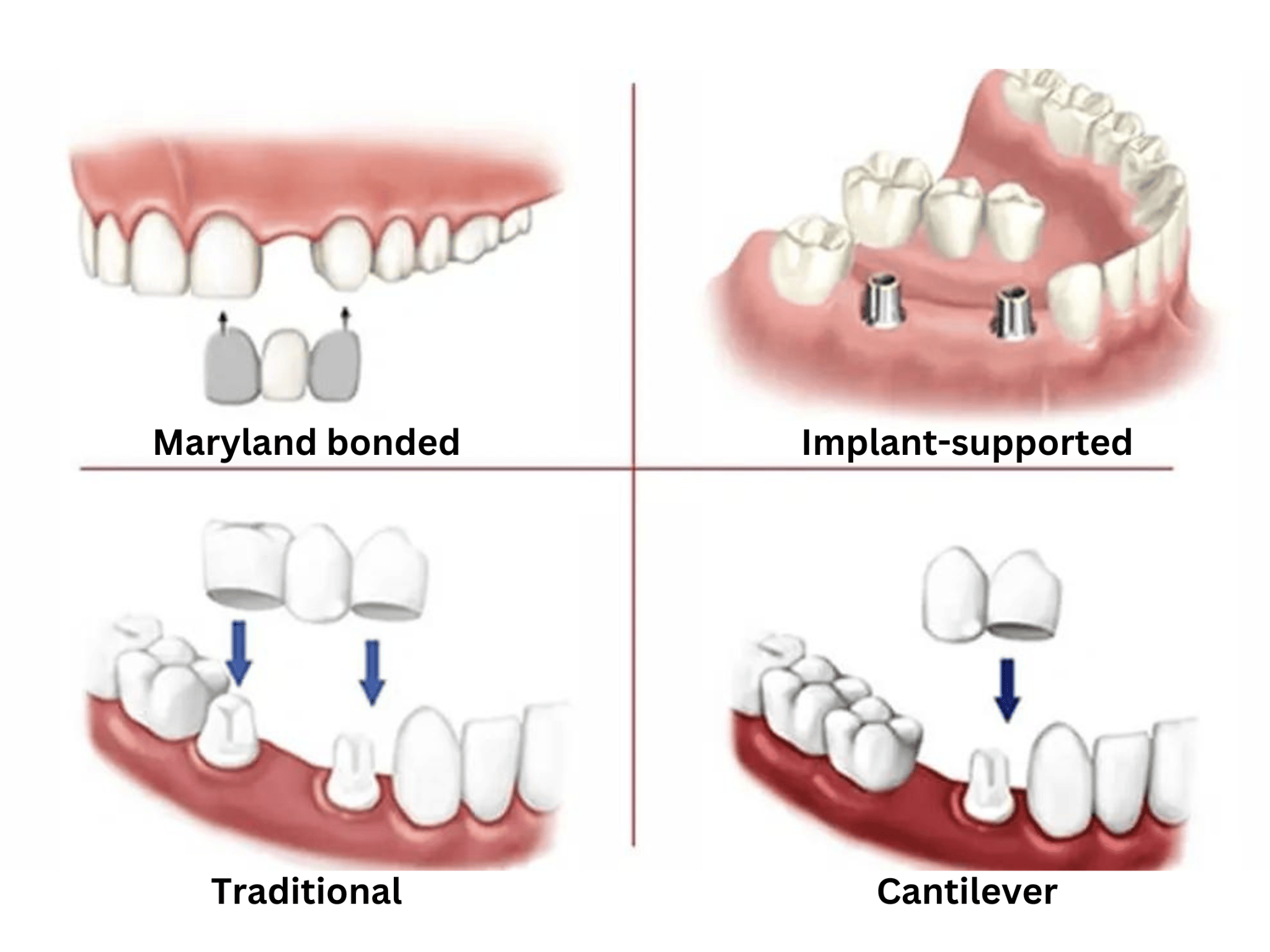 Types_of_Dental_Bridge.png