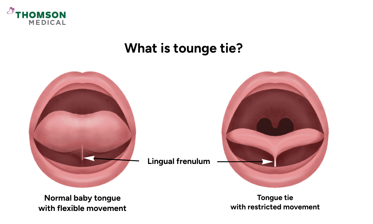 image of what is tongue tie