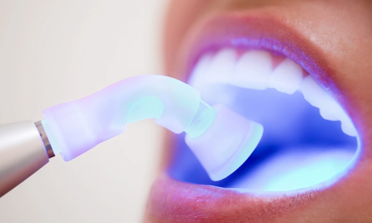 dentist using uv light to harden teeth