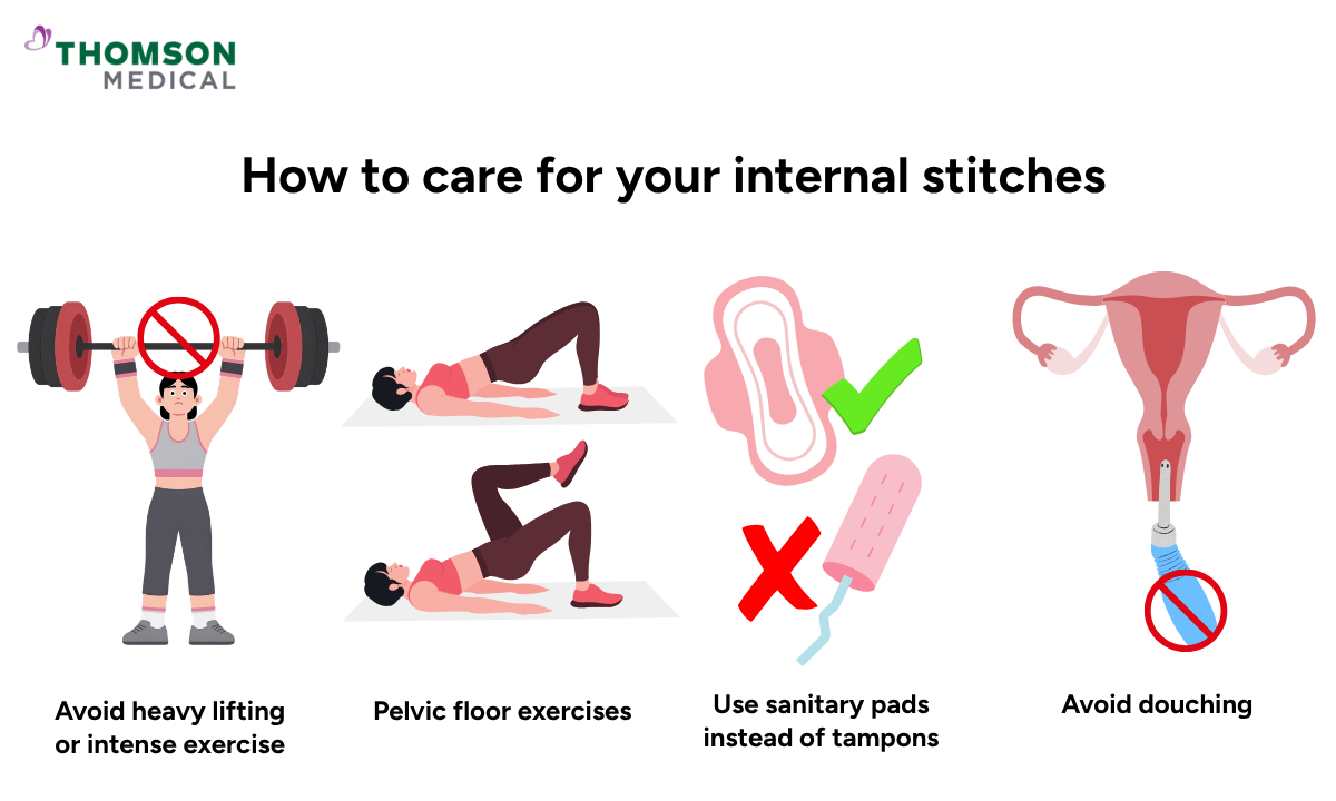 Illustration of how to care for your internal stitches after a hysterectomy