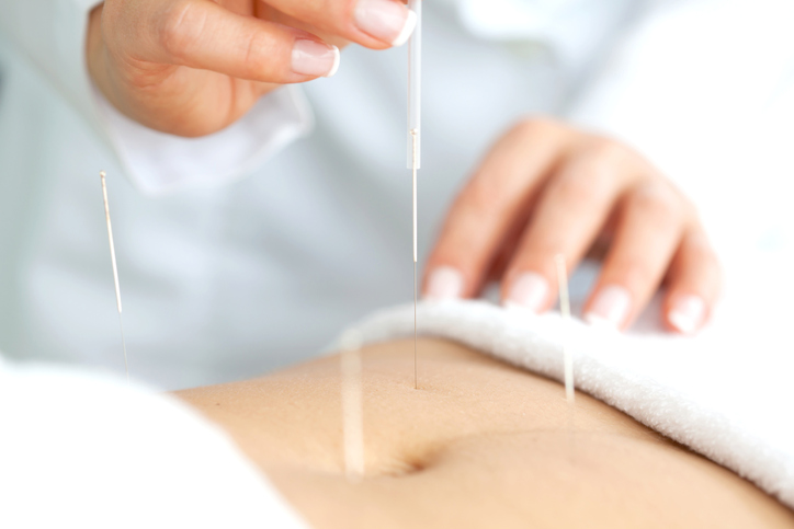 traditional chinese medicine physician placing acupuncture needles around abdomen of a patient