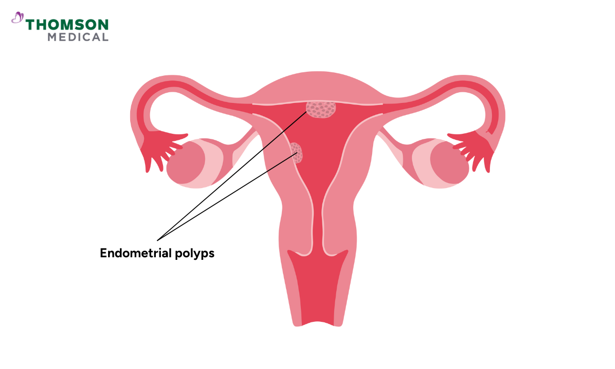 Illustration of endometrial polyps