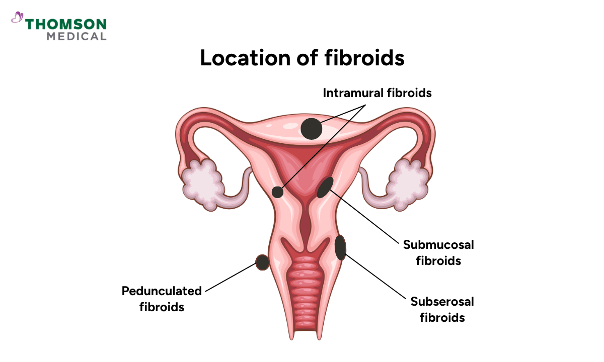 illustration of the fibroids location