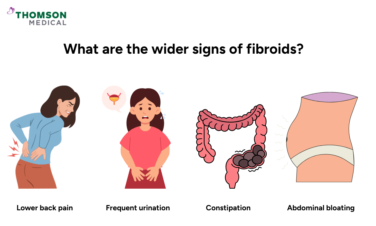 Illustration shows the wider signs of fibroids