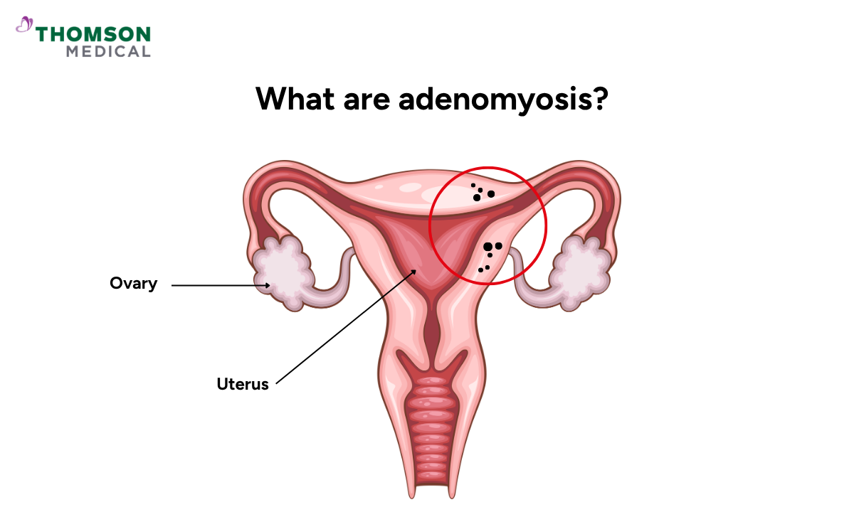 adenomyosis