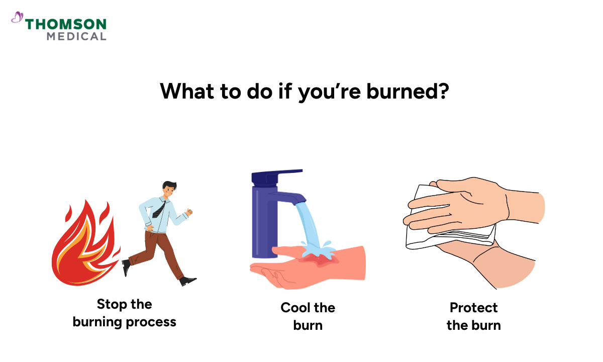 blog-image_ucc_what-to-do-if-you-are-burned.png