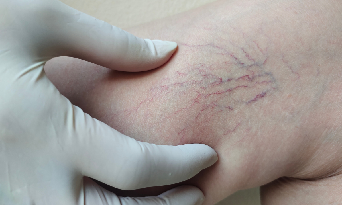 A medical professional's gloved hand examining visible spider veins and varicose veins on a patient's leg.