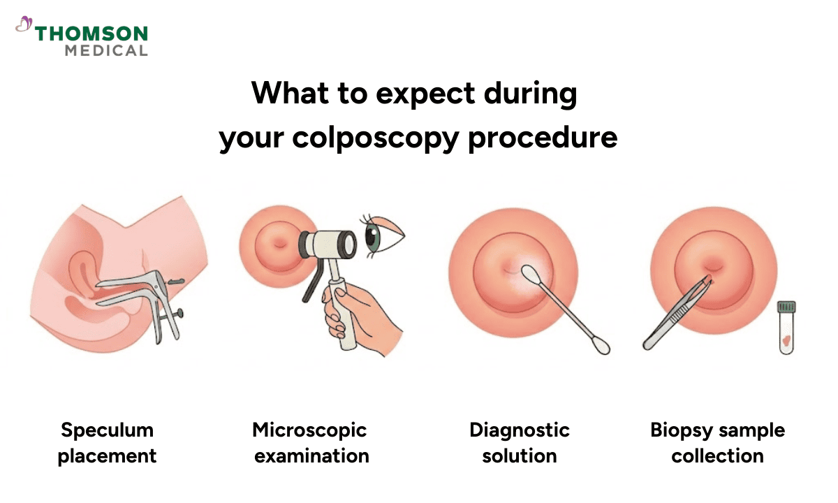 An infographic on what to expect during your colposcopy procedure, showing speculum placement, microscopic examination, application of a diagnostic solution, and biopsy sample collection.