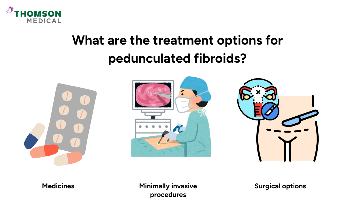 Illustration shows the treatment options for pedunculated fibroids