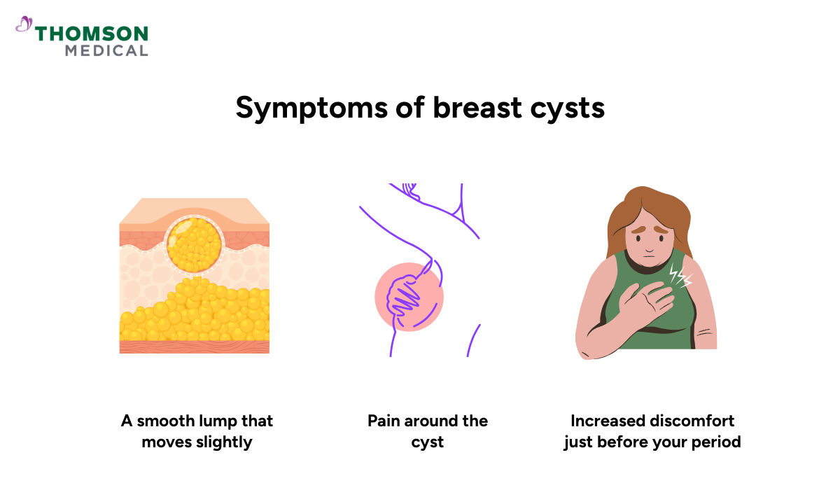 Common symptoms of breast cysts