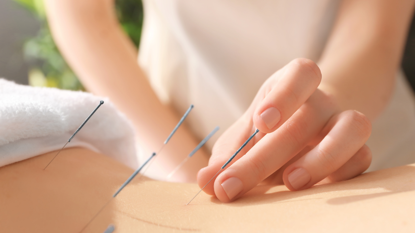 women experiencing acupuncture