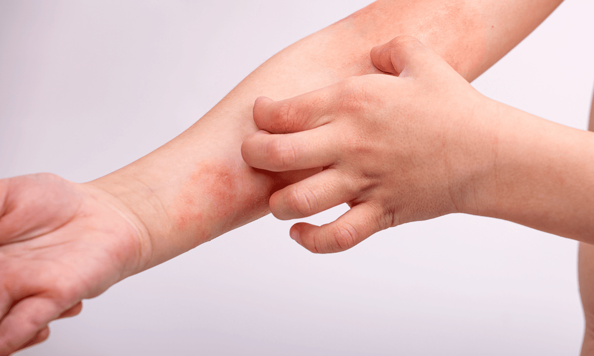 image of eczema in kid