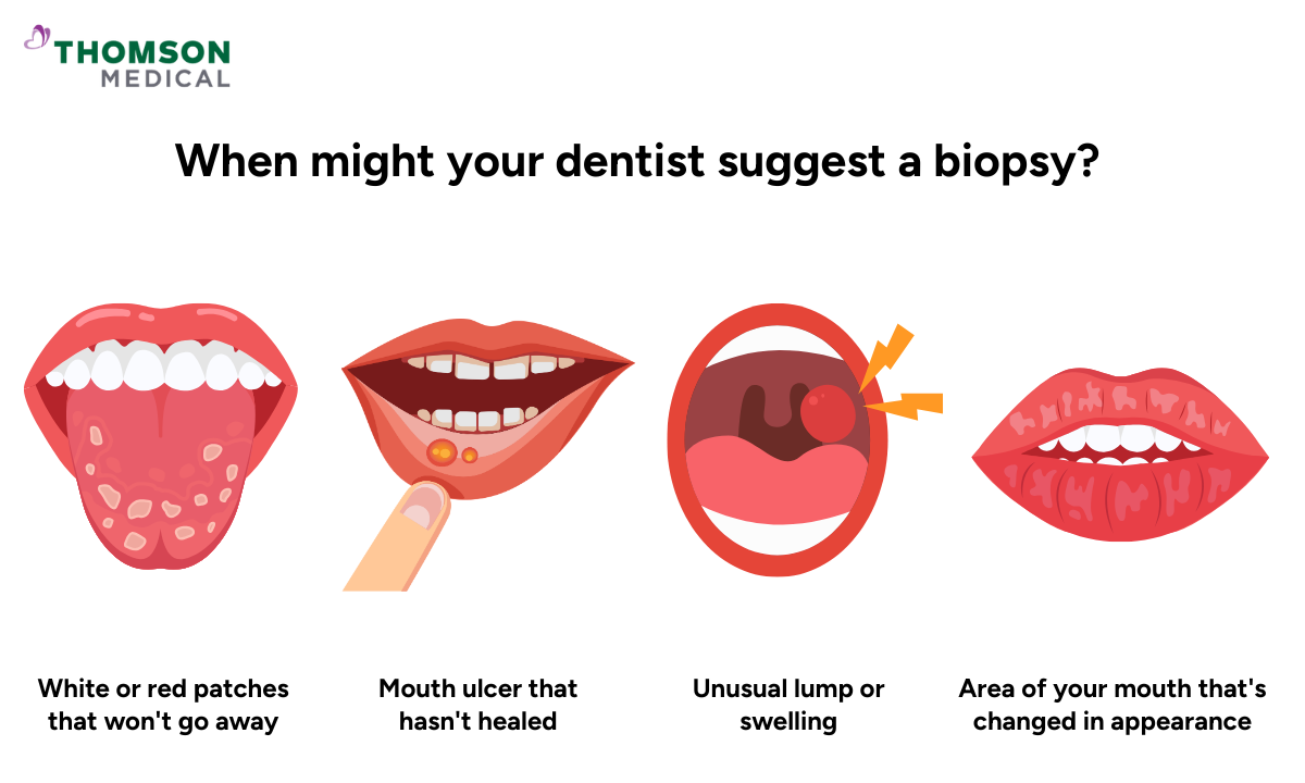 Illustration of situations when the dentist might suggest a biopsy