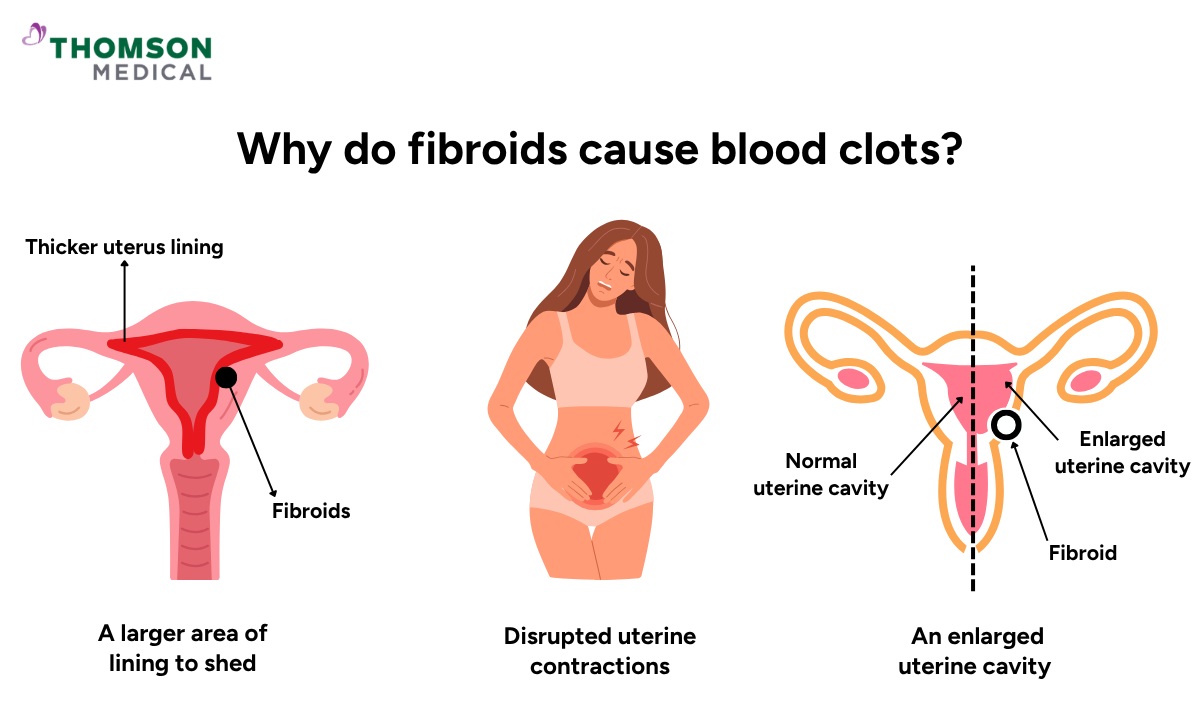 Illustration on why do fibroids cause blood clots