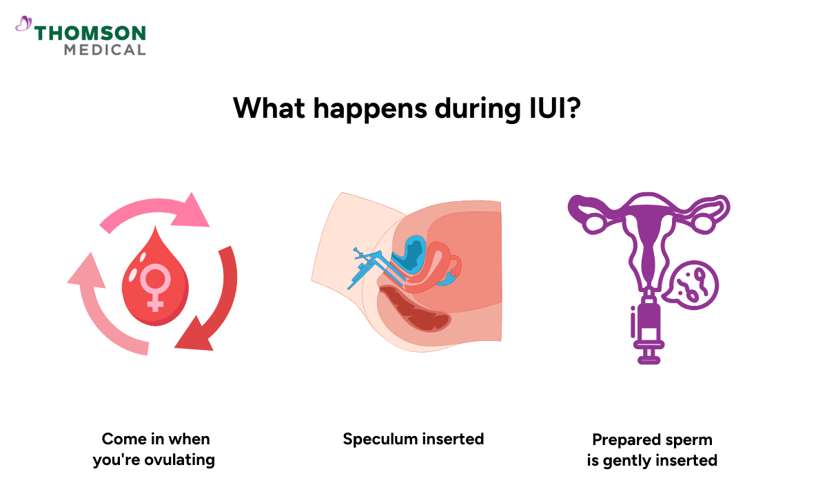 What happens during IUI