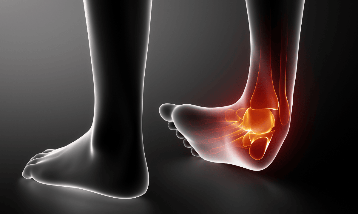 Illustration of an ankle sprain