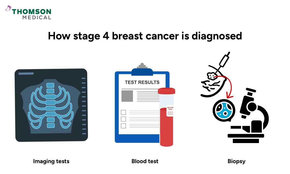 Illustration of how is stage 4 breast cancer diagnosed