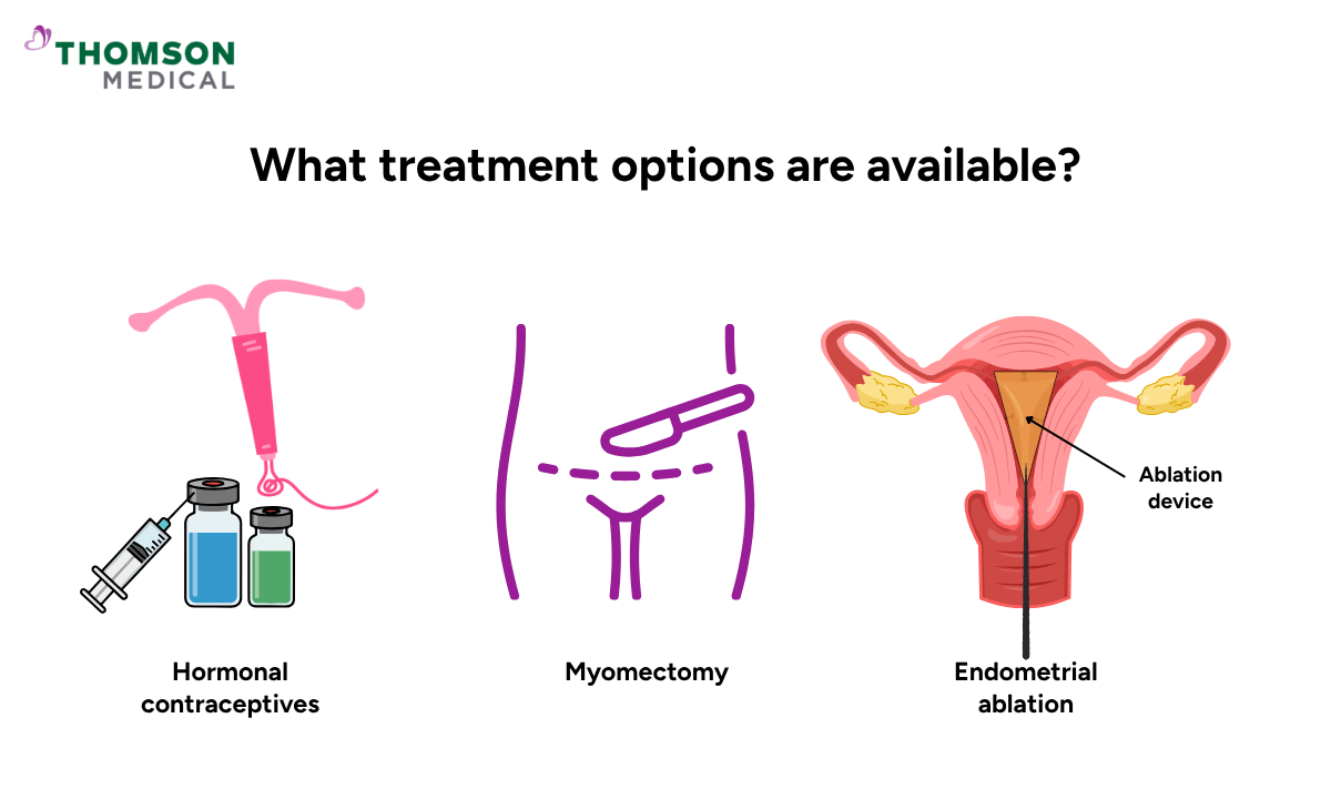 illustration of what treatment options are available for fibroids