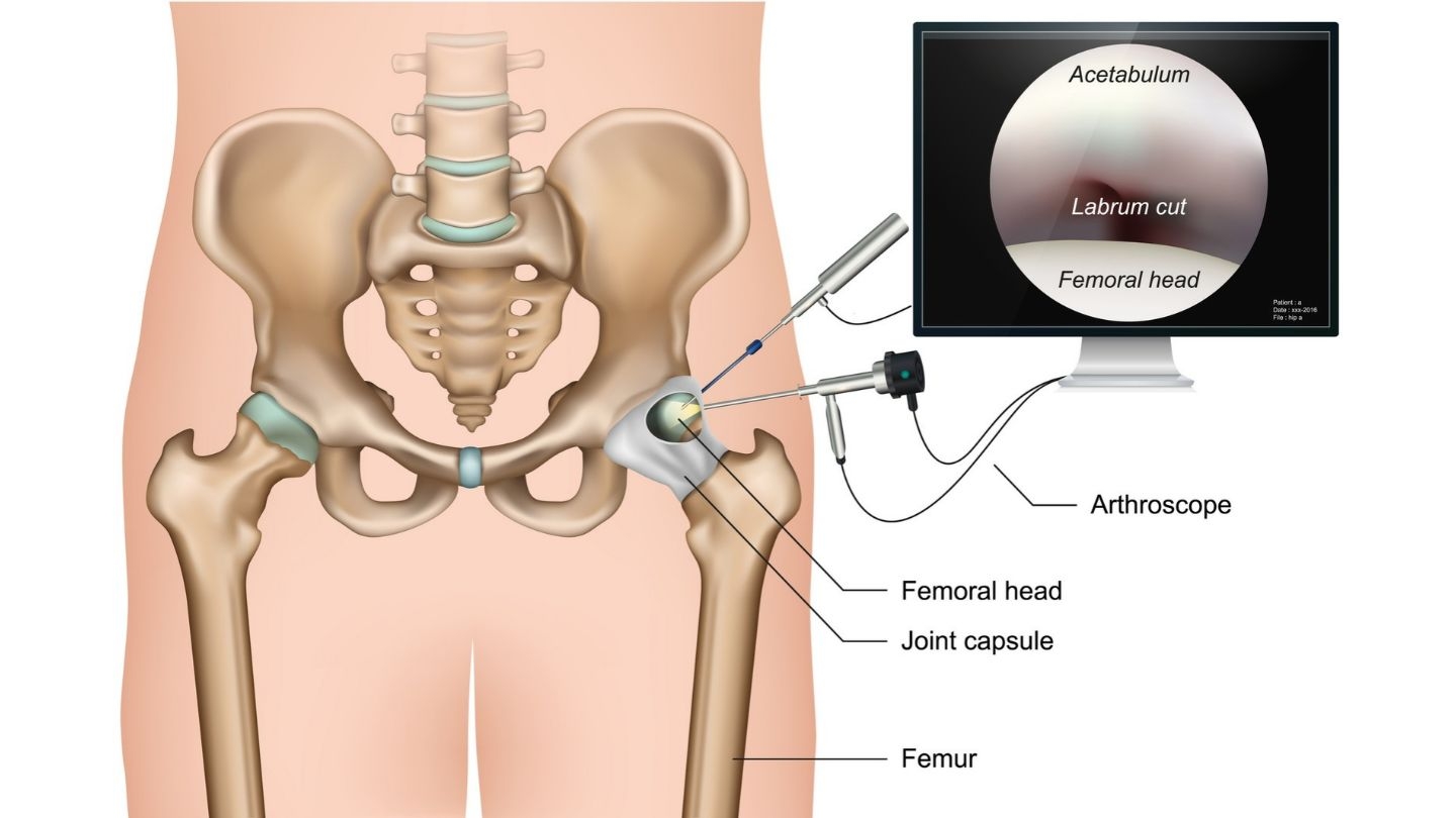 a-guide-on-a-minimally-invasive-hip-arthroscopy.jpg