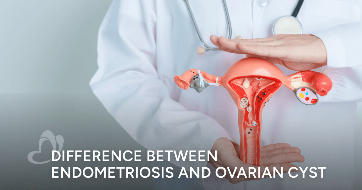 Difference Between Endometriosis And Ovarian Cyst: Everything You ...