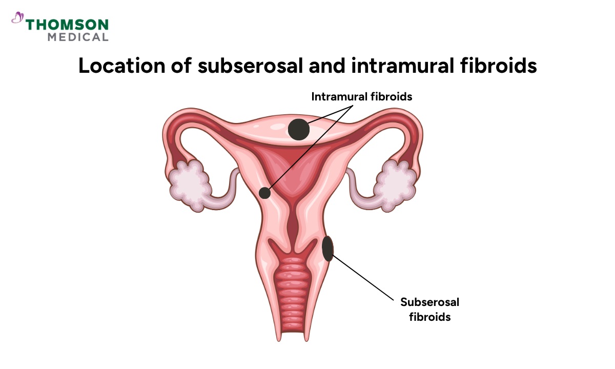 illustration of fibroids most likely to cause bladder issues