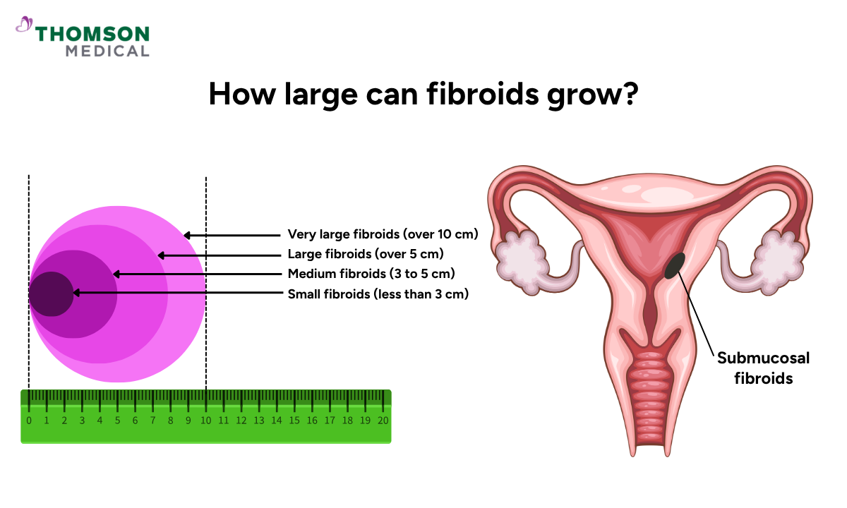 Illustration on how large can fibroids grow