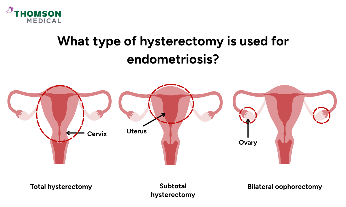 Illustration of what type of hysterectomy is used for endometriosis