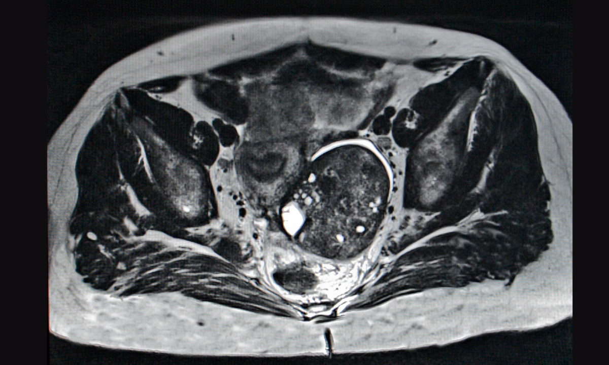 blog-image_cancer_mri-scan-of-ovarian-cancer.png