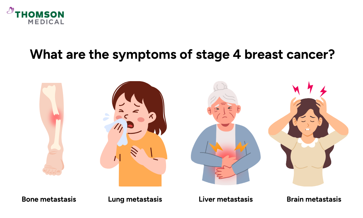 Illustration of the symptoms of stage 4 breast cancer